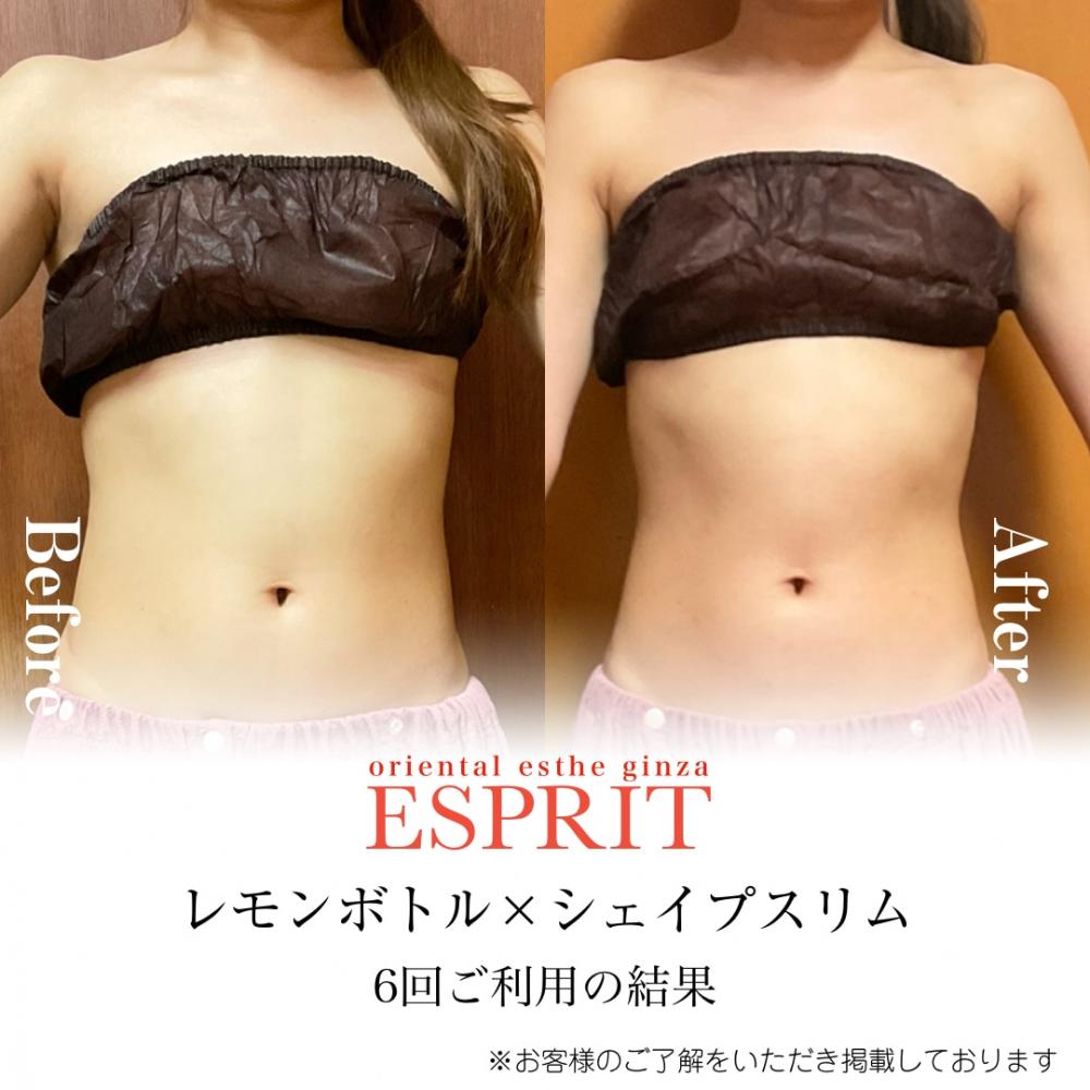 【Before→After】レモンボトル×シェイプスリム 6回の施術でこの変化…!