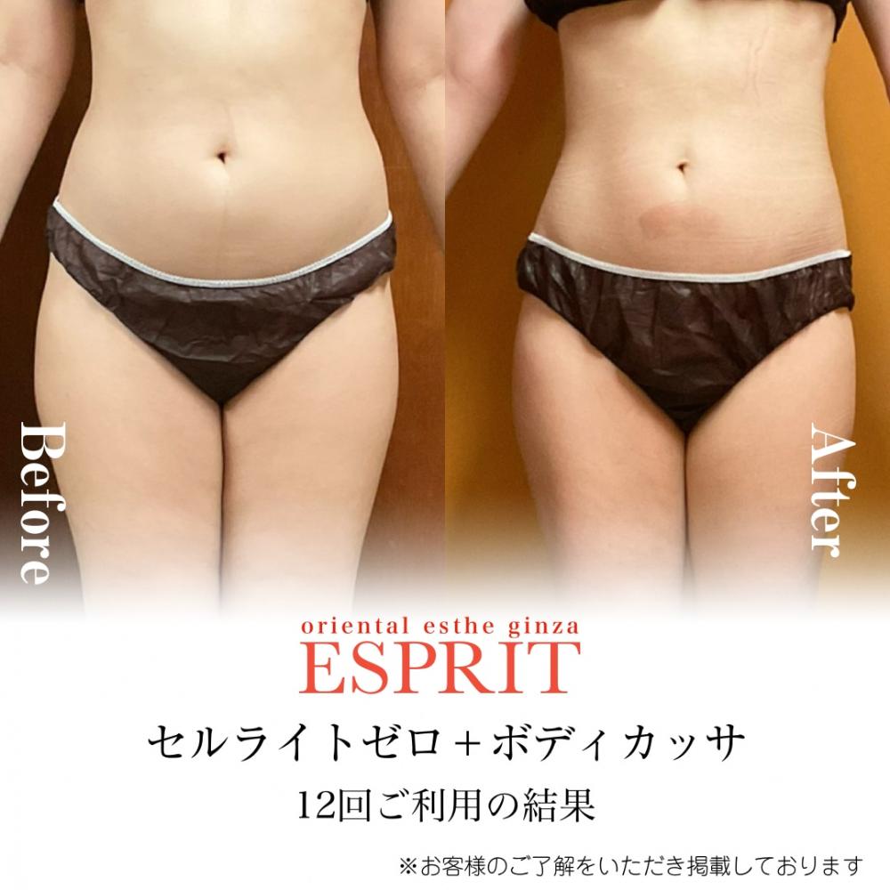 【Before→After公開】セルライトゼロ+ボディカッサ<レモンボトル×シェイプスリム>