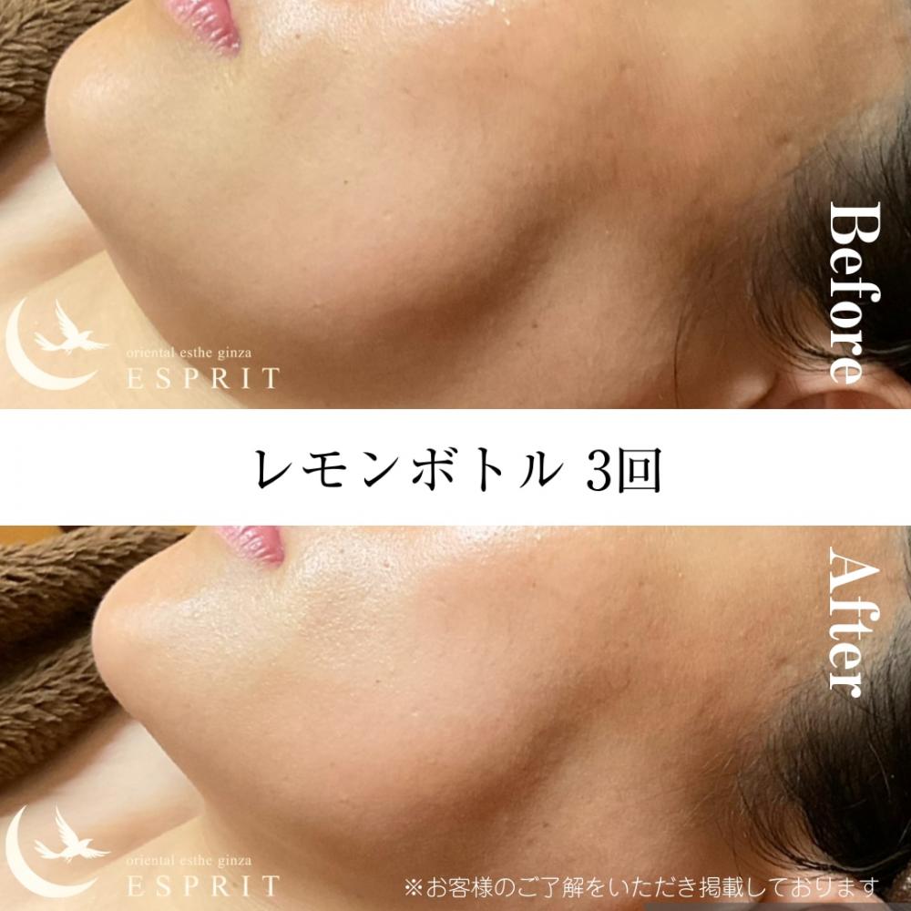 レモンボトル 3回(フェイスライン)
