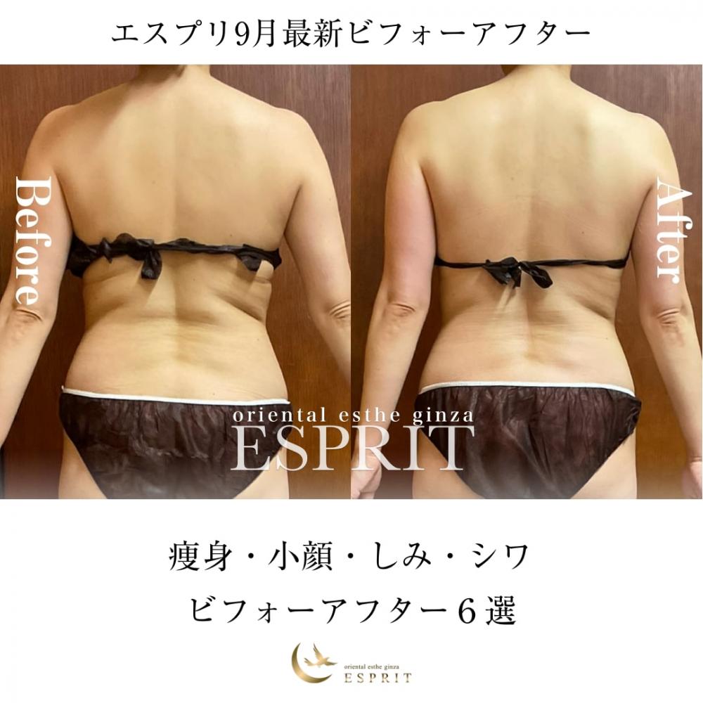 【2025年9月】痩身・小顔・しみ・しわ!ビフォーアフター事例6選!