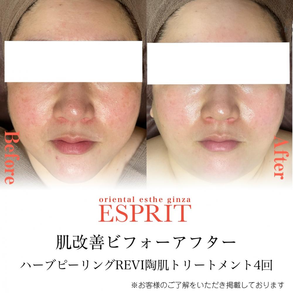 4回ですごくきれいになりました