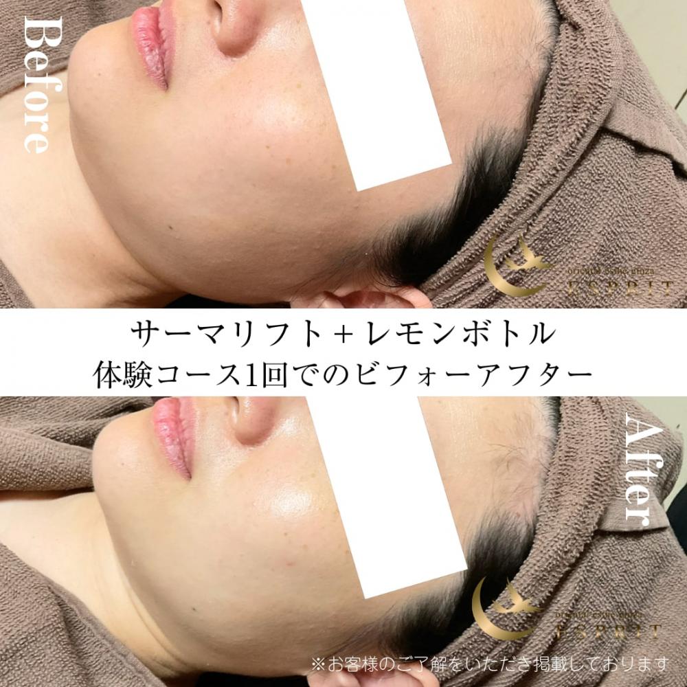 小顔エステビフォーアフター!