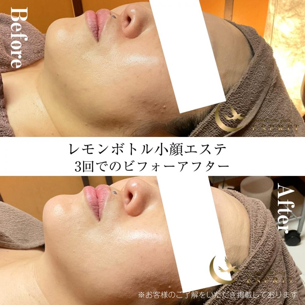 レモンボトル小顔エステのビフォーアフター!