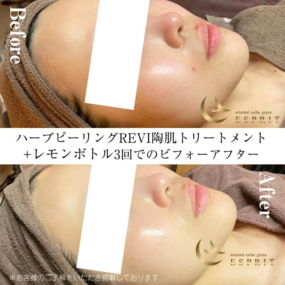 美肌+小顔ケアのビフォーアフター