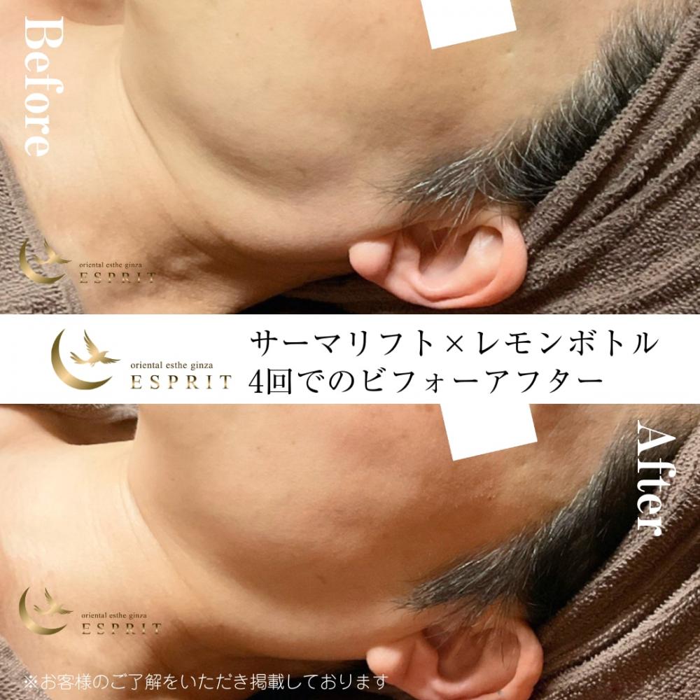 レモンボトル小顔フェイスリフトケア