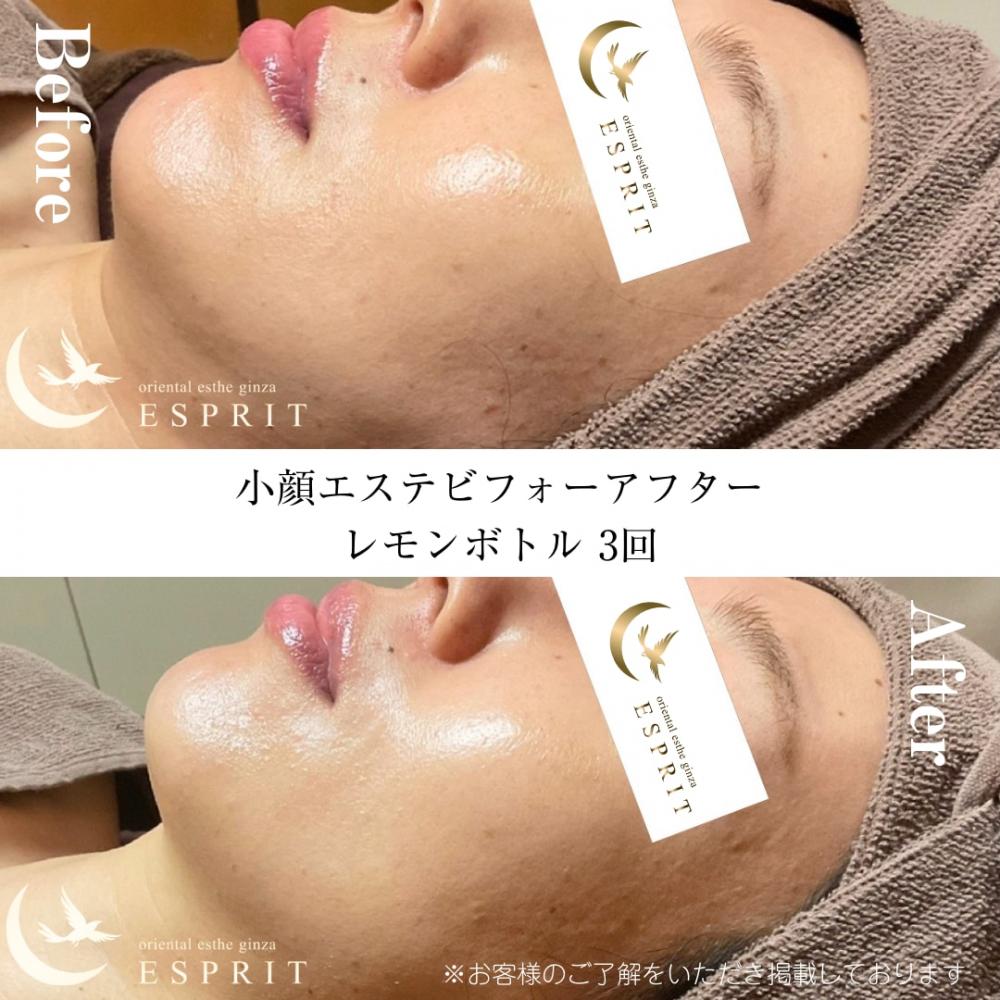 レモンボトル小顔エステのビフォーアフターを大公開!