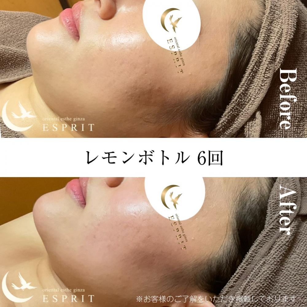 レモンボトル6回のビフォーアフター公開